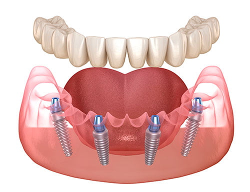 All-on-4 dental implants supporting a full arch prosthesis in the lower jaw