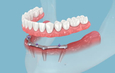 What Are All-on-4 Dental Implants?