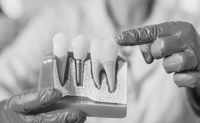 Dentist holding a dental implant model while explaining tooth replacement options to a patient.