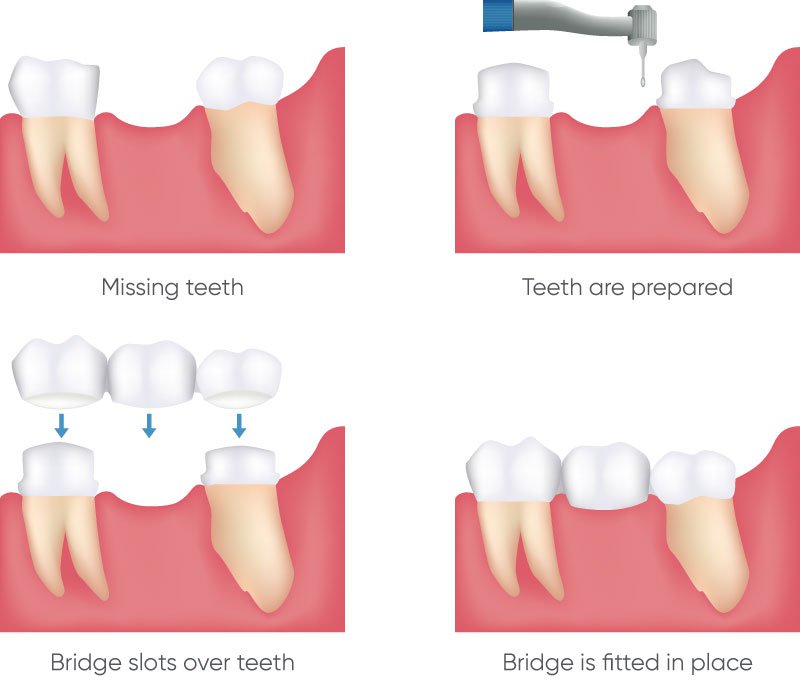 Dental Bridge Installation Process.jpg