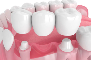 What is a dental bridge.webp