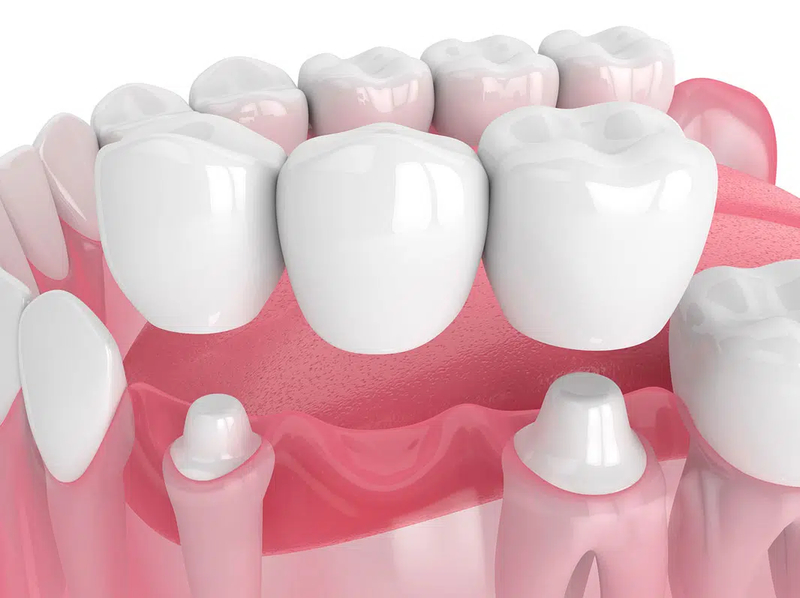 What is a dental bridge.webp