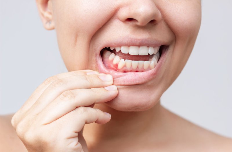 Red Lump on Gum Near Tooth Representing Gingivitis Symptom