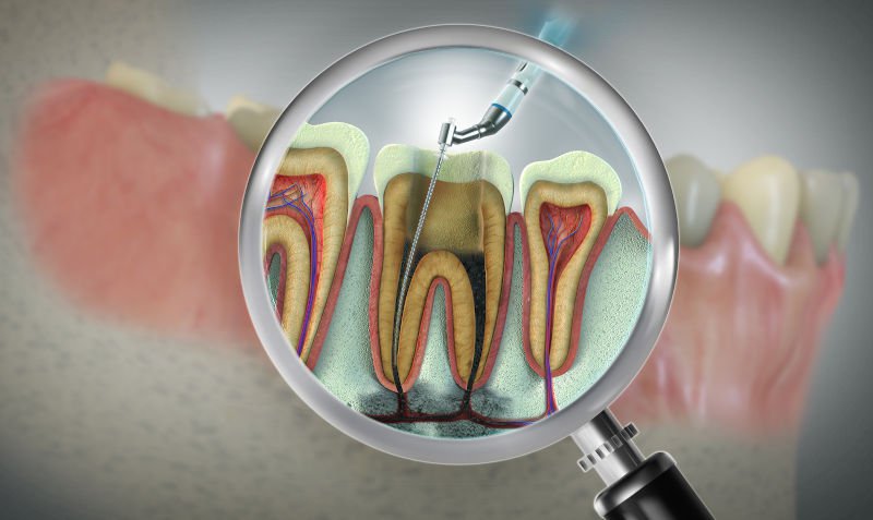 Dental illustration showing root canal treatment and the number of canals in different teeth